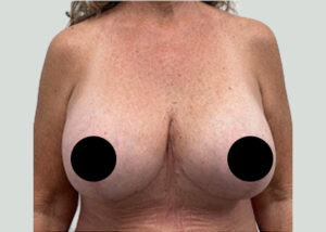Breast Augmentation by Dr. Michael Frederick — after