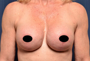 Breast Augmentation by Dr. Michael Frederick — after