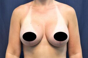 Breast Augmentation by Dr. Michael Frederick — after