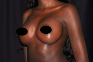 Breast Augmentation by Dr. Michael Frederick — after