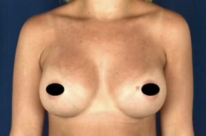 Breast Augmentation by Dr. Michael Frederick — after