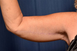 Arm Lift by Dr. Michael Frederick — after
