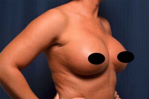 Breast Augmentation by Dr. Michael Frederick — after
