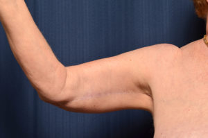 Arm Lift by Dr. Michael Frederick — after