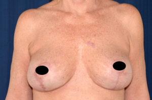 Breast Augmentation by Dr. Michael Frederick — after