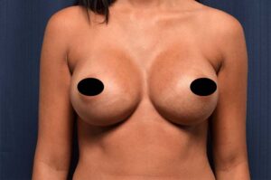 Breast Augmentation by Dr. Michael Frederick — after