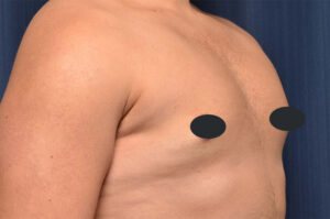 Other procedures by Dr. Michael Frederick — after