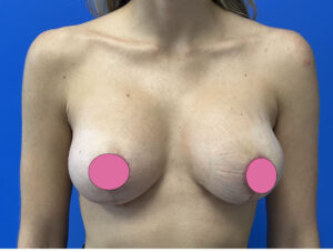 Breast Augmentation by Dr. Michael Frederick — after