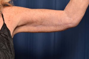 Arm Lift by Dr. Michael Frederick — after