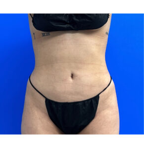 BBL by Dr. Michael Frederick — after