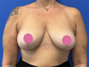 Breast Augmentation by Dr. Michael Frederick — after