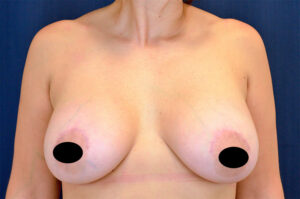 Breast Augmentation by Dr. Michael Frederick — after