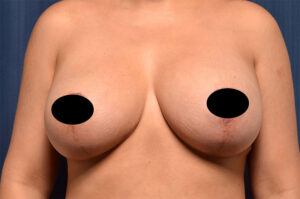 Breast Augmentation by Dr. Michael Frederick — after