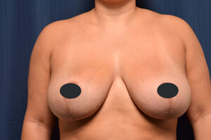 Other procedures by Dr. Michael Frederick — after