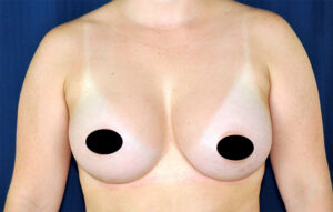 Breast Augmentation by Dr. Michael Frederick — after