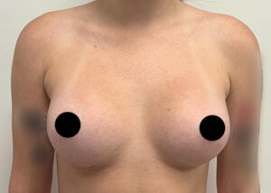 Breast Augmentation by Dr. Michael Frederick — after
