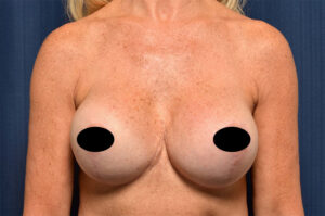 Breast Augmentation by Dr. Michael Frederick — after
