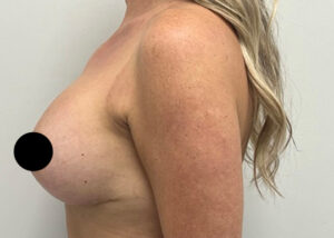 Breast Augmentation by Dr. Michael Frederick — after