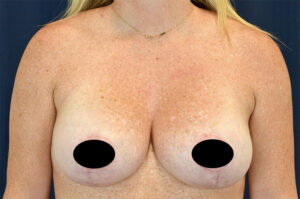 Breast Augmentation by Dr. Michael Frederick — after