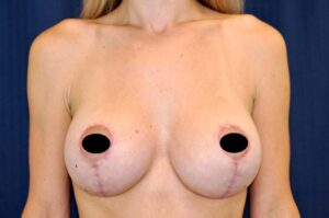Breast Augmentation by Dr. Michael Frederick — after