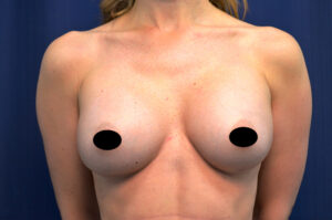 Breast Augmentation by Dr. Michael Frederick — after