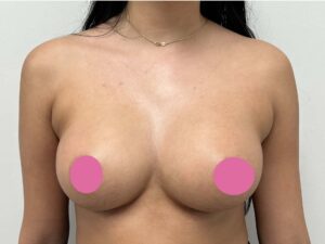 Breast Augmentation by Dr. Michael Frederick — after