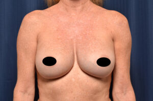Breast Augmentation by Dr. Michael Frederick — after
