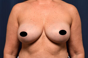 Breast Augmentation by Dr. Michael Frederick — after