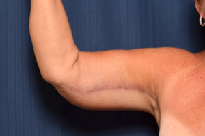 Arm Lift by Dr. Michael Frederick — after