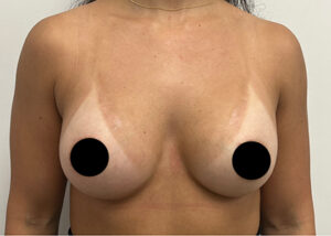 Breast Augmentation by Dr. Michael Frederick — after