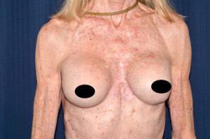 Breast Augmentation by Dr. Michael Frederick — after