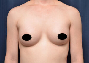 Other procedures by Dr. Michael Frederick — after