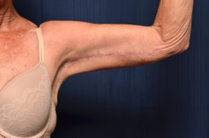 Arm Lift by Dr. Michael Frederick — after