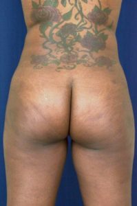 BBL by Dr. Michael Frederick — after