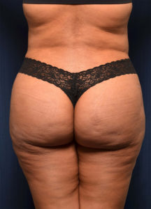 BBL by Dr. Michael Frederick — after