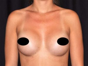 Breast Augmentation by Dr. Michael Frederick — after