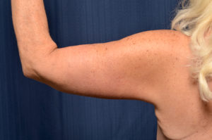 Arm Lift by Dr. Michael Frederick — after
