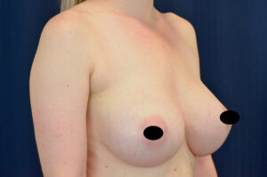 Breast Augmentation by Dr. Michael Frederick — after
