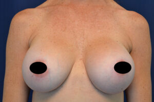 Breast Augmentation by Dr. Michael Frederick — after