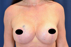 Breast Augmentation by Dr. Michael Frederick — after