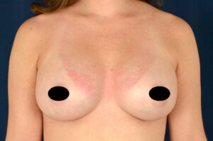 Breast Augmentation by Dr. Michael Frederick — after