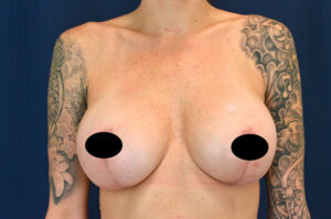 Breast Augmentation by Dr. Michael Frederick — after