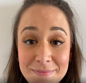 Botox by Dr. Michael Frederick — after