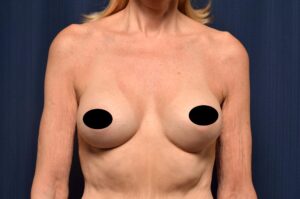 Breast Augmentation by Dr. Michael Frederick — after