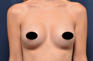 Breast Augmentation by Dr. Michael Frederick — after