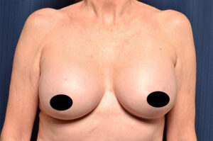 Breast Augmentation by Dr. Michael Frederick — after