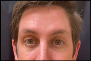 Botox by Dr. Michael Frederick — after