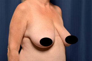 Breast Augmentation by Dr. Michael Frederick — before
