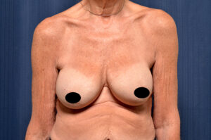 Breast Augmentation by Dr. Michael Frederick — before