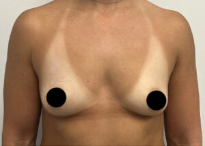Breast Augmentation by Dr. Michael Frederick — before